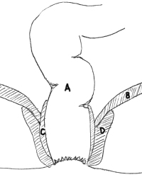 illustration af endetarm