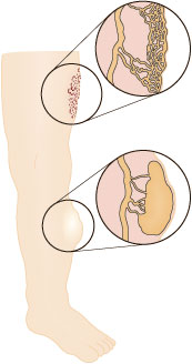 illustration af Lymfatisk Malformation