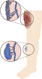 Illustration af Venøs malformation